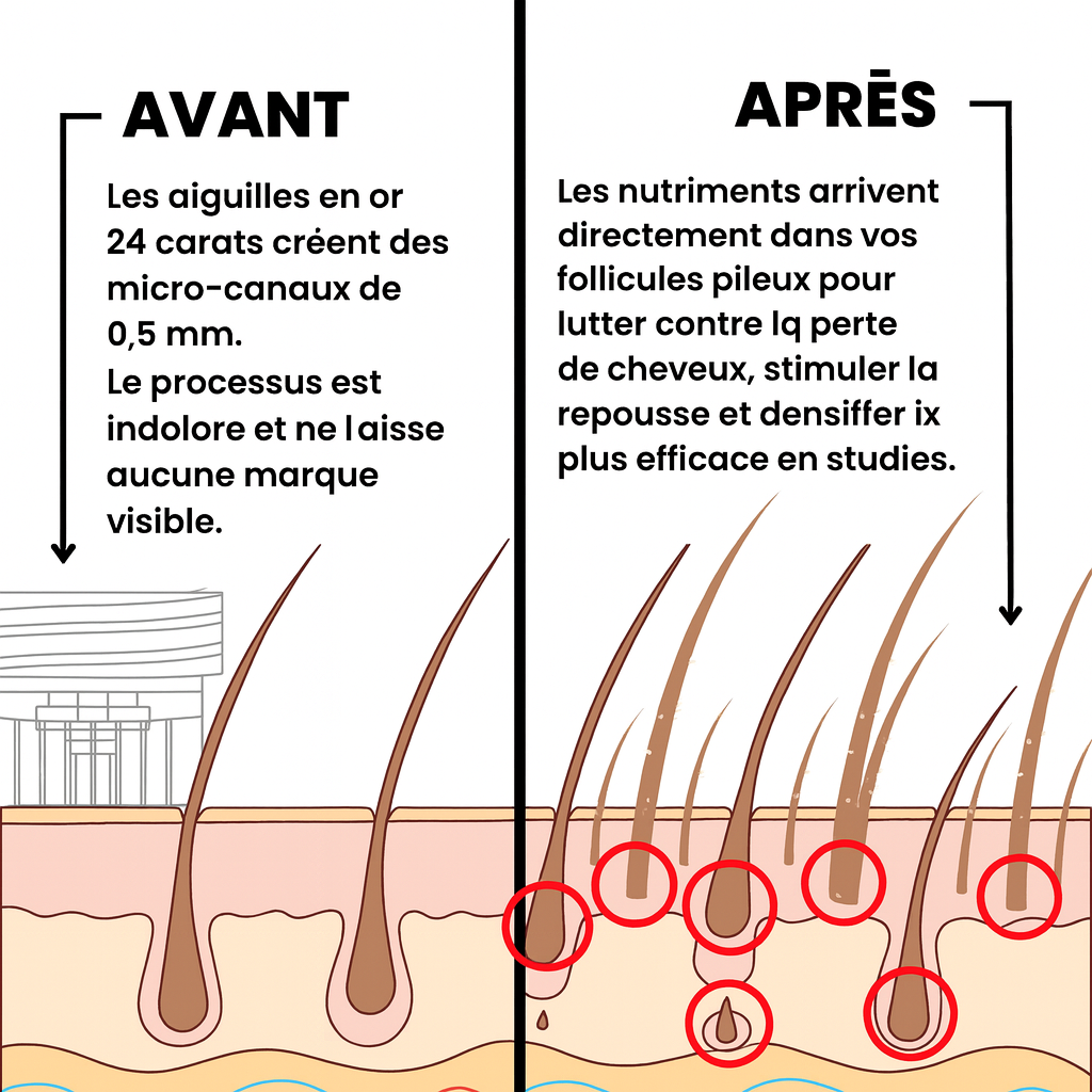 Système de Repousse Capillaire ALPHA Infuse™